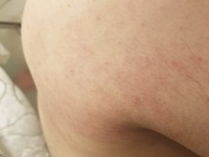 shingles rash virus 